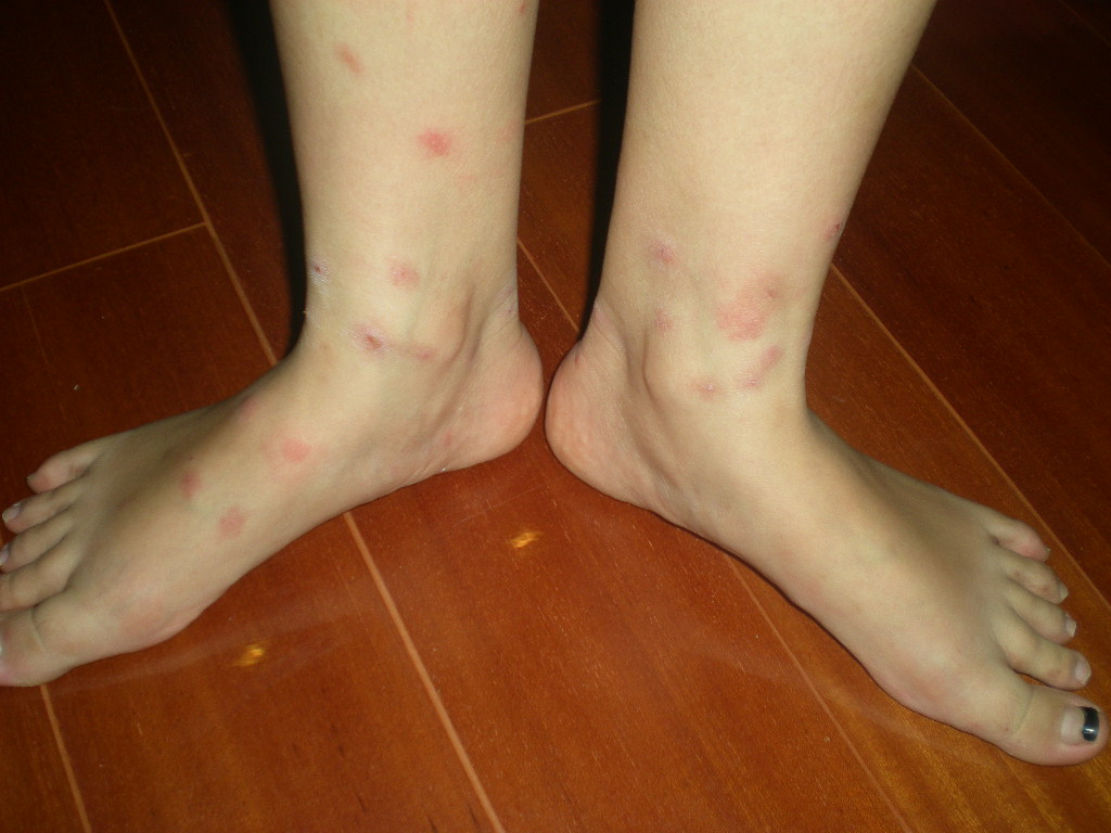 腳被跳蚤咬傷癥狀